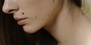 שומות מולדות