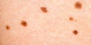 שומות דיספלסטיות