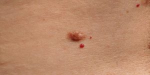 שומות נפוצות